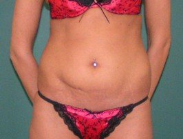 lipo_pries-1_1