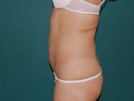 lipo_pries-2_0