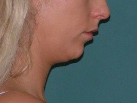 lipo_pries-3